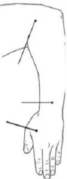 Body na ruce od bolesti hlavy